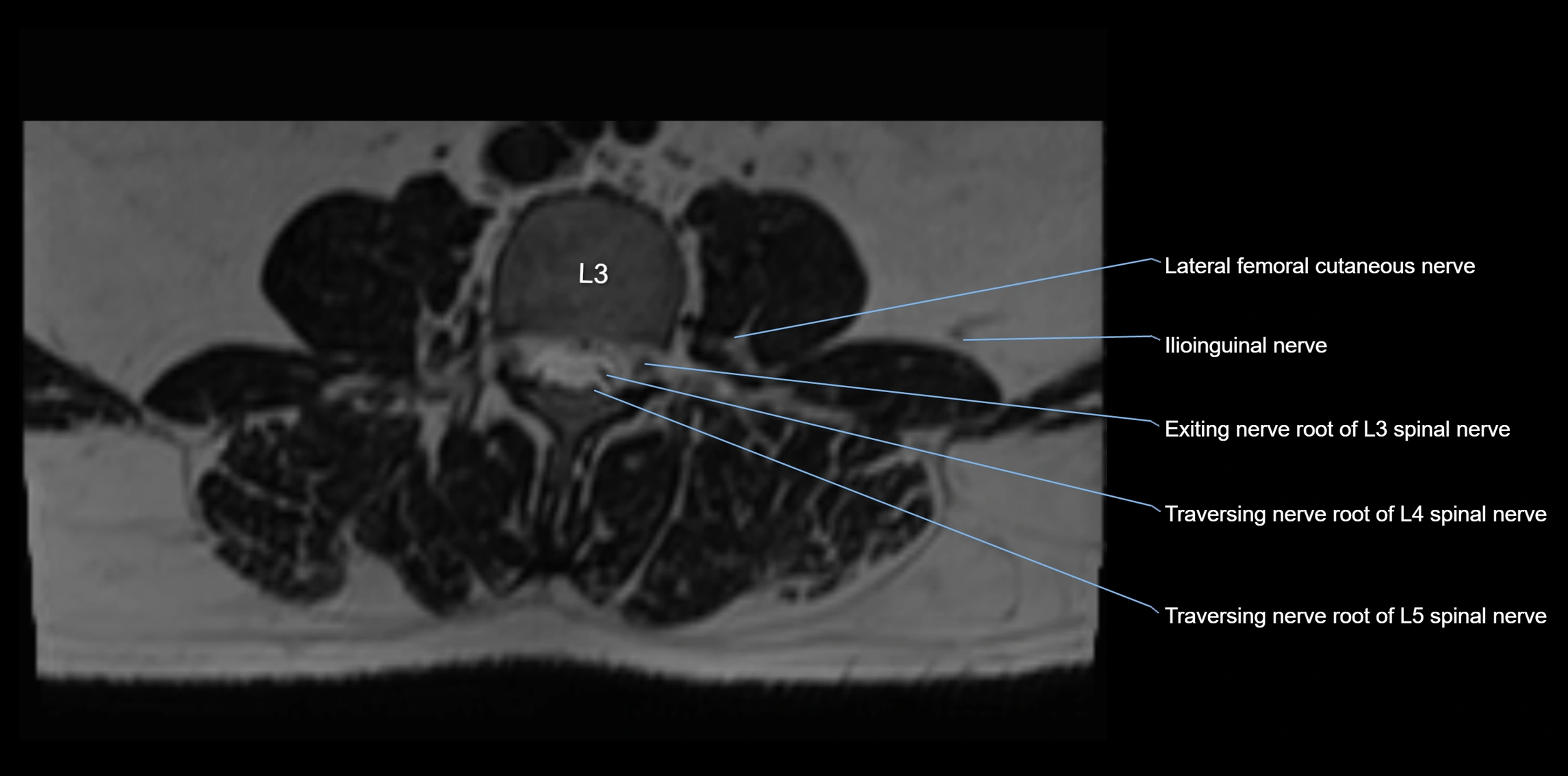 MR lumbosacral plexus axial cross sectional anatomy 3T  radiology  image-img-1008001-00023.webp